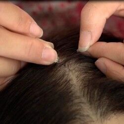 Hair human transplant